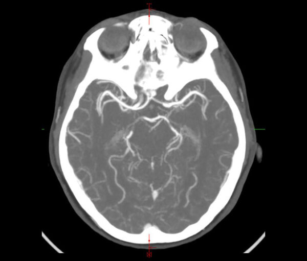 Brain CT Scan Angiography