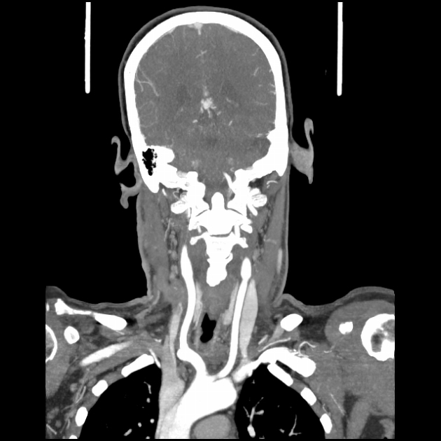 Brain CT Scan & Neck Angiography