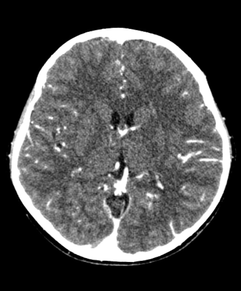 Brain with Contrast