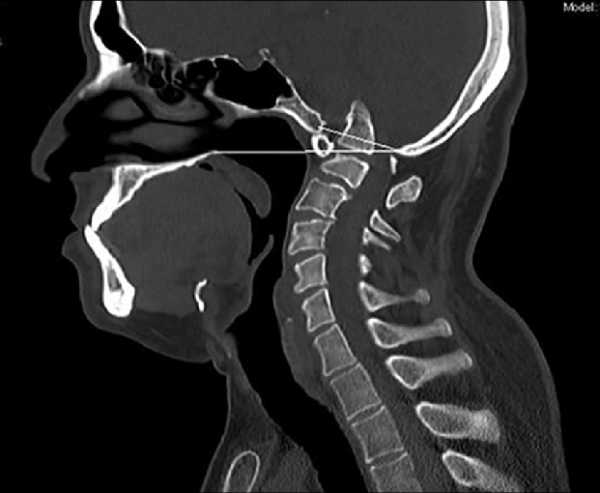 CVJ 3D Recon (Craniovertebral Junction)