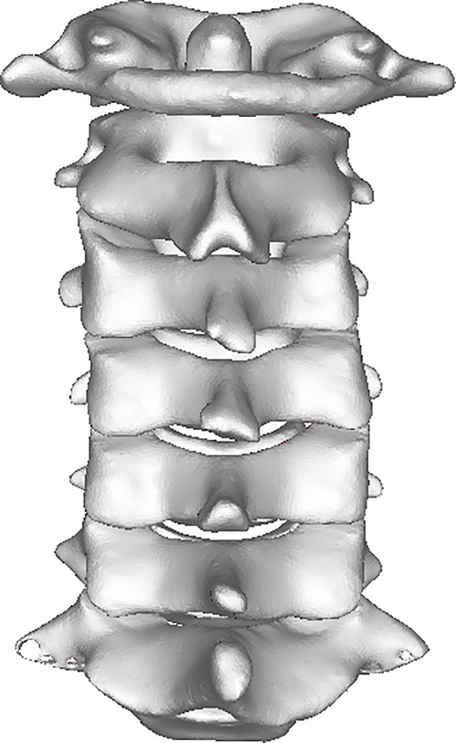 Cervical spine 3D Recon