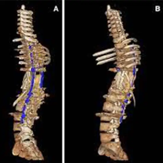 Dorsolumbar spine 3D Recon