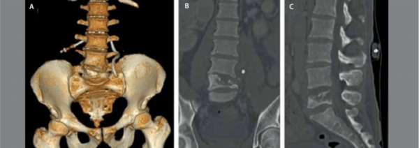 Lumbar spine 3D Recon