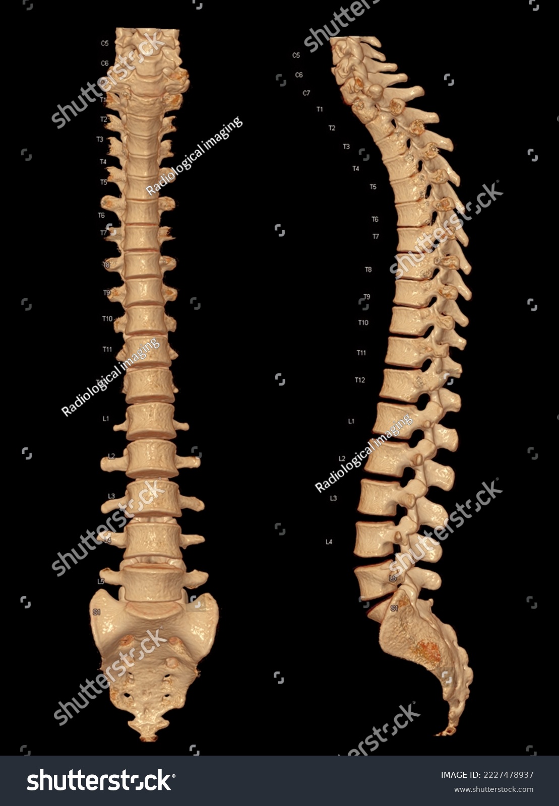 Whole Spine 3D Recon