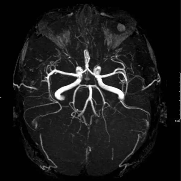 Brain Angio With Contrast