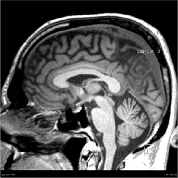 Brain with Neurodegenration Protocol (MRI)