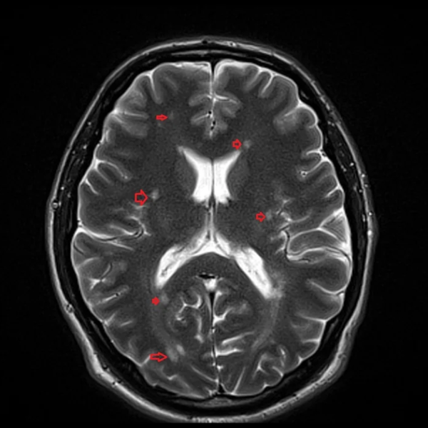 Brain with MS protocol (Multiple Sclerosis) (MRI)