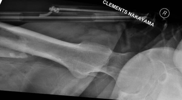 Clements-Nakayama view