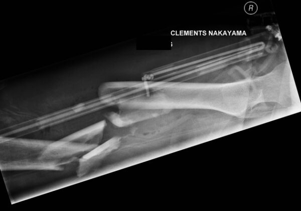 Modified  Axiolateral View (Clements-Nakayama)