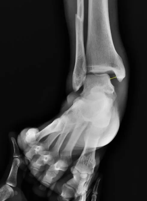 Normal-ankle-radiology-AP-6