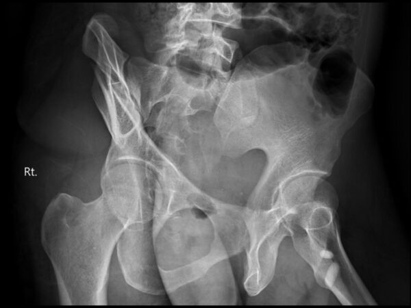 Oblique views (Judet views)