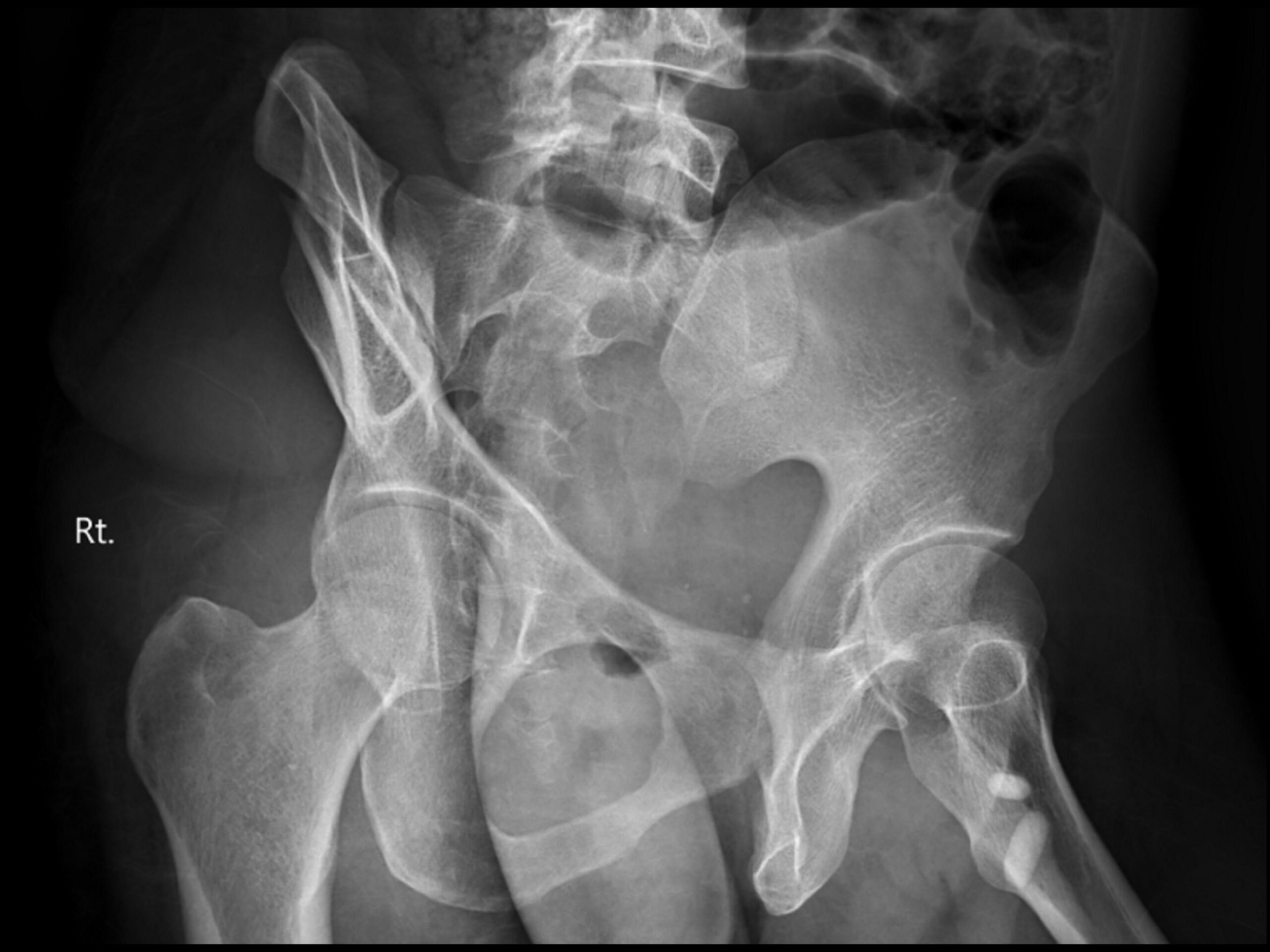 Oblique views (Judet views), Pelvis,Hip, X-Ray