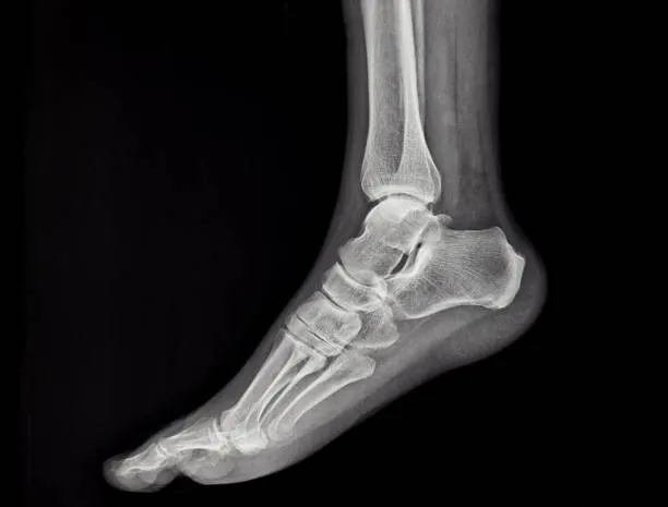 an-x-ray-of-the-sole-of-the-human-foot