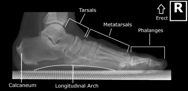 Weight bearing lateral view