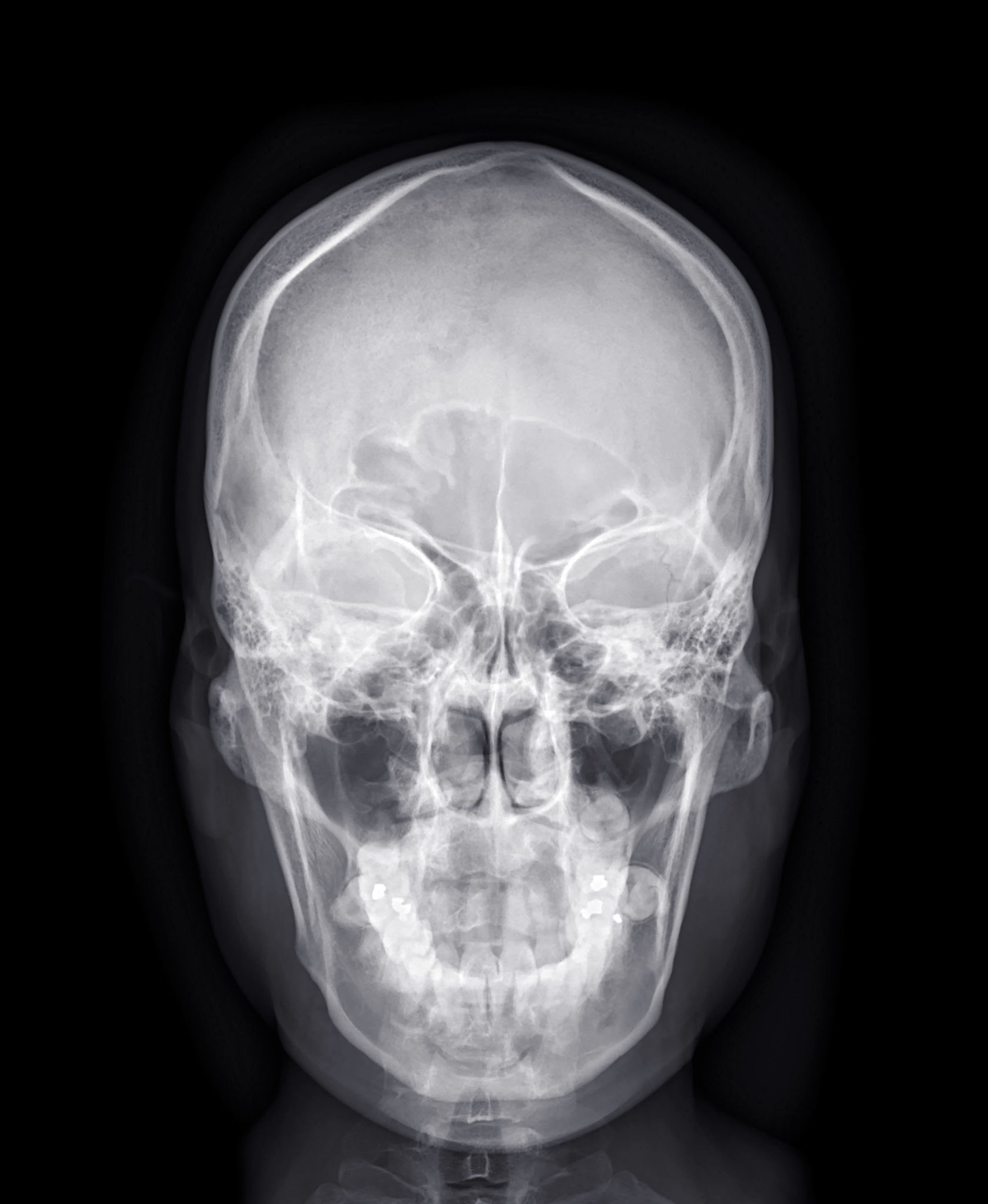 AP View, Skull, X-Ray