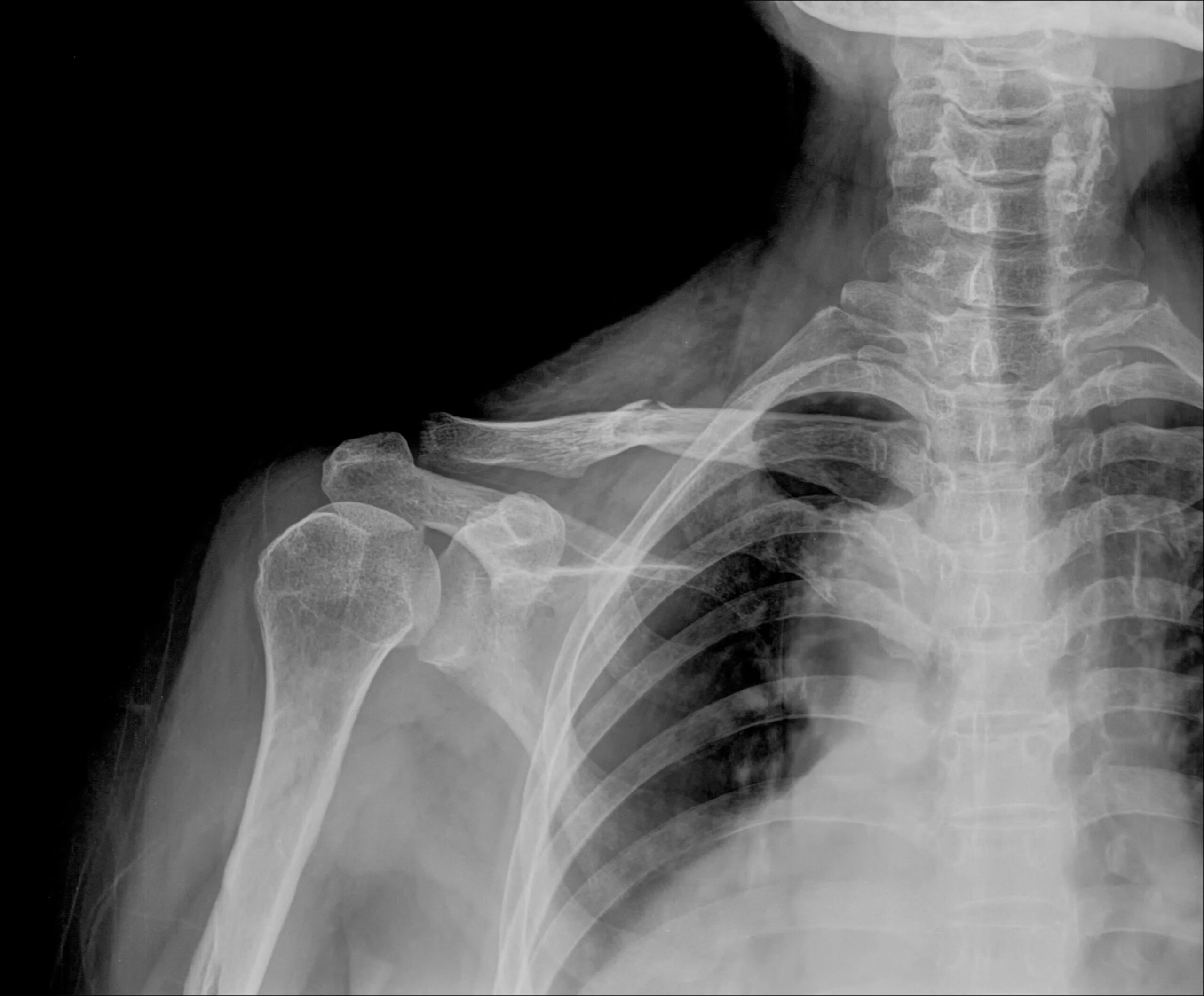 AP view, Clavicle, X-Ray
