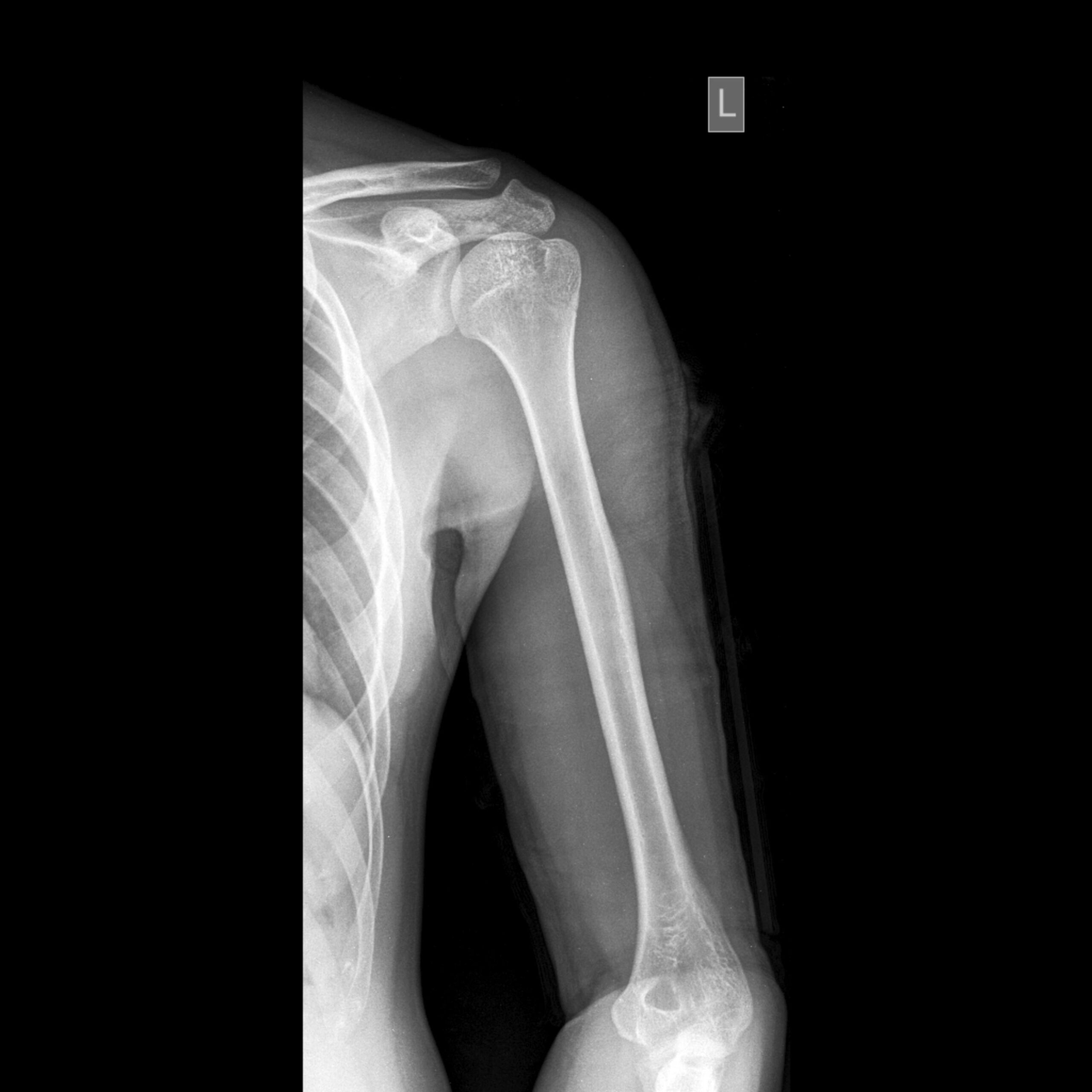 AP view, Humerus, X-Ray