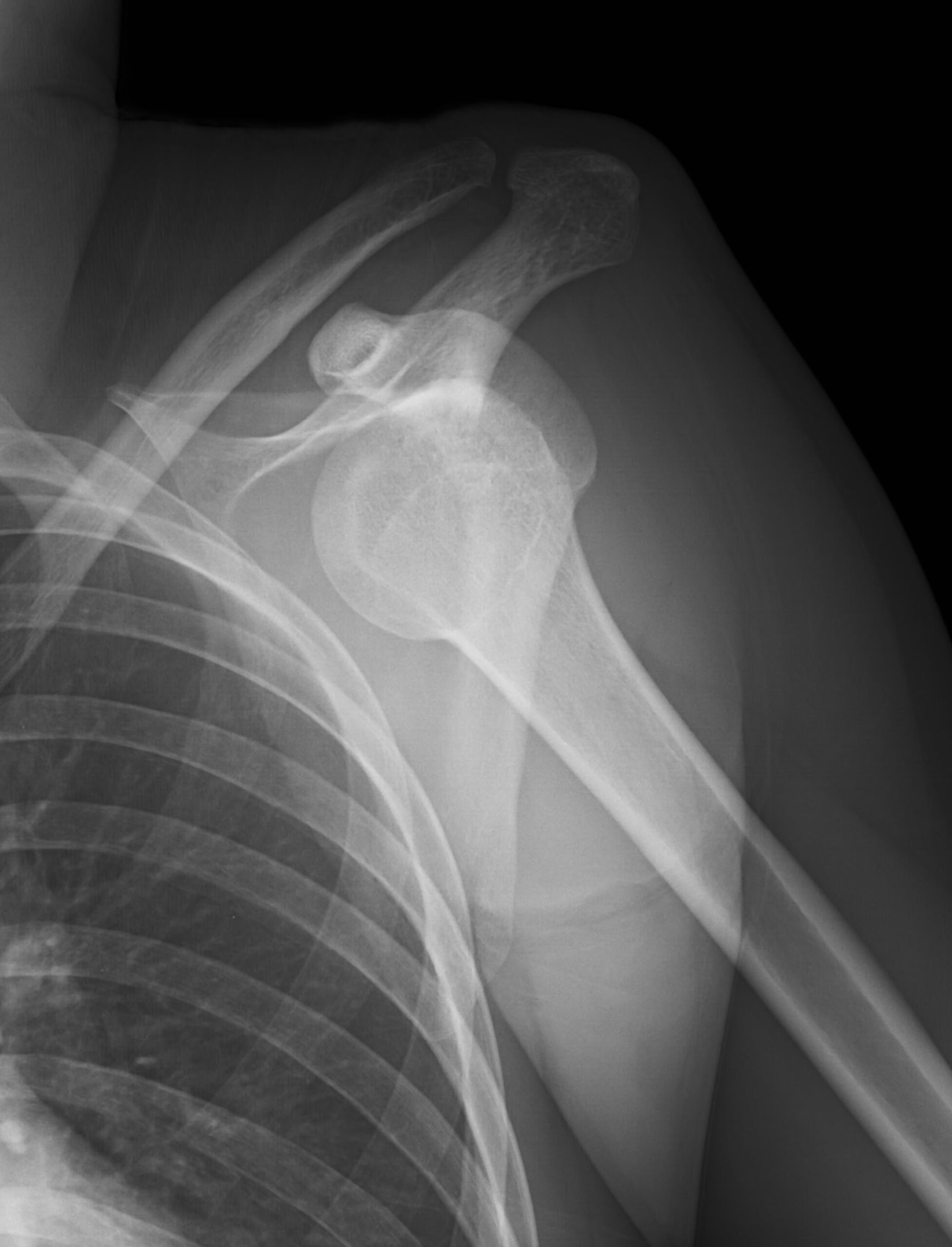 AP view, Shoulder, X-Ray