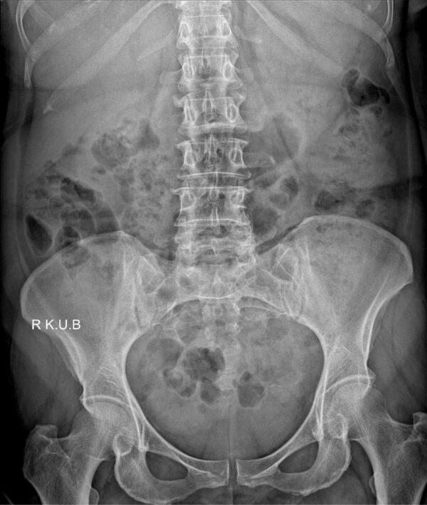 Abdomen AP Supine