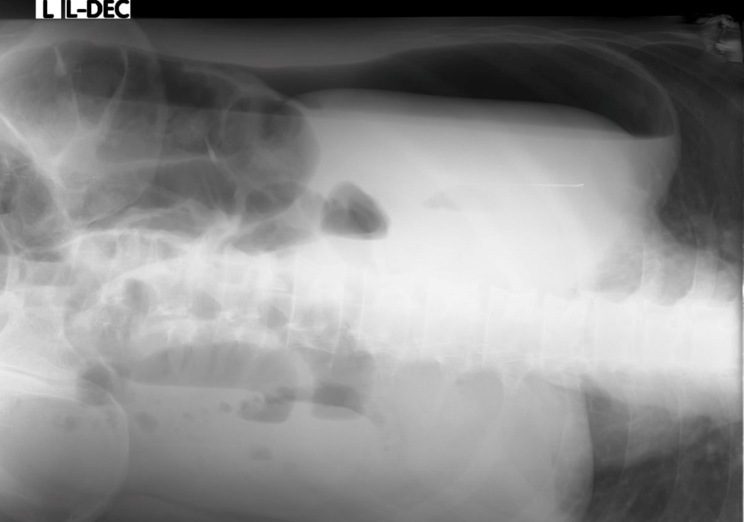 Abdomen, Abdomen Dorsal Decubitus, X-Ray