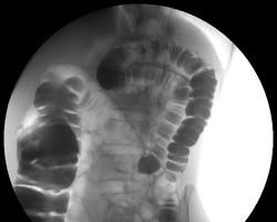 Abdomen, Abdomen Oblique Views, X-Ray