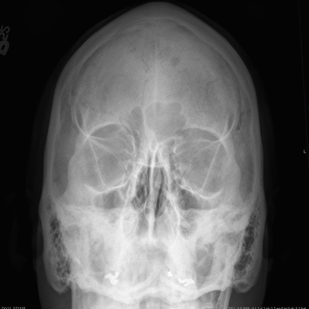 Caldwell’s View (Occipitofrontal), PNS (Nasal Bones), X-Ray