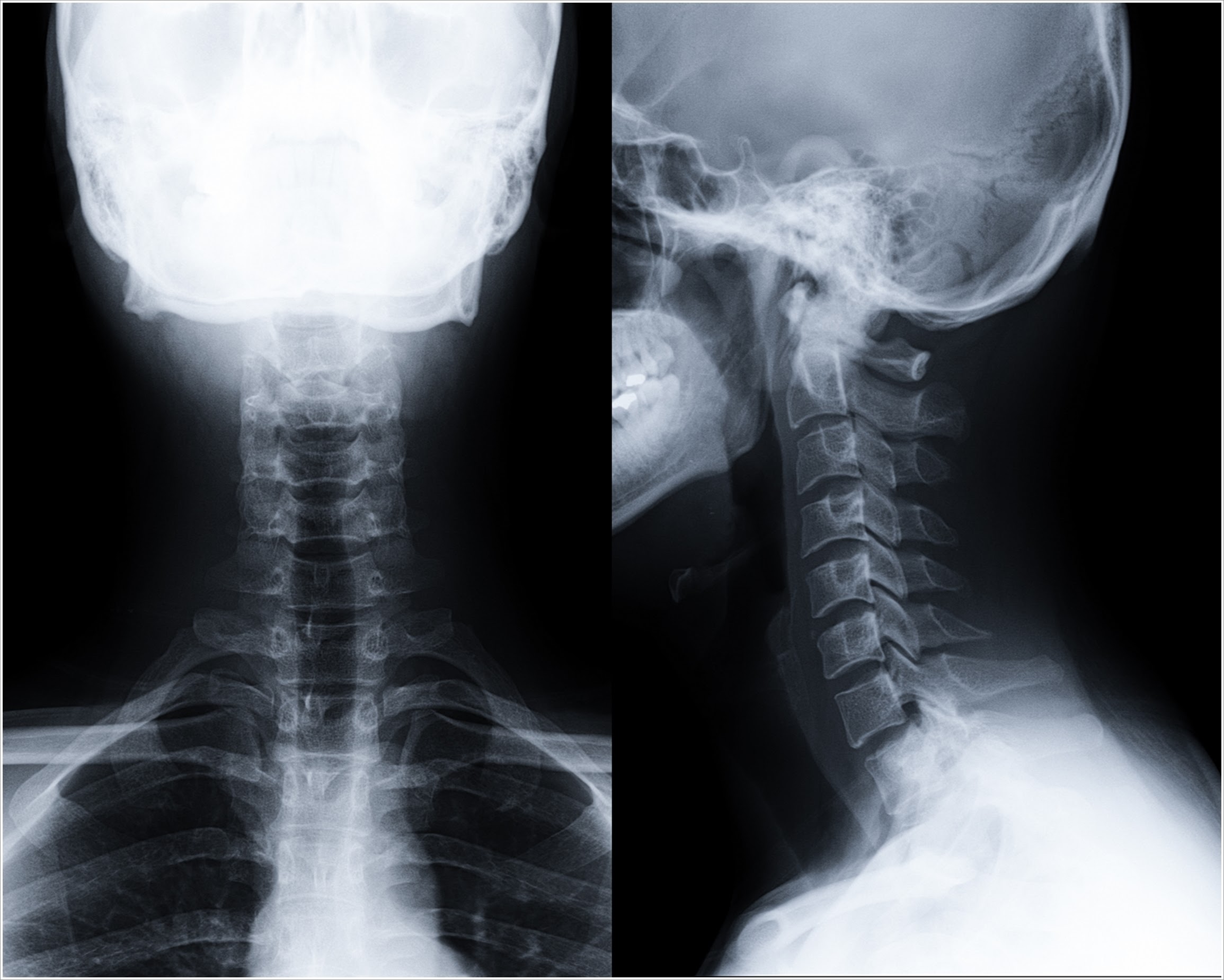 Cervical spine AP,LAT, Spine, X-Ray