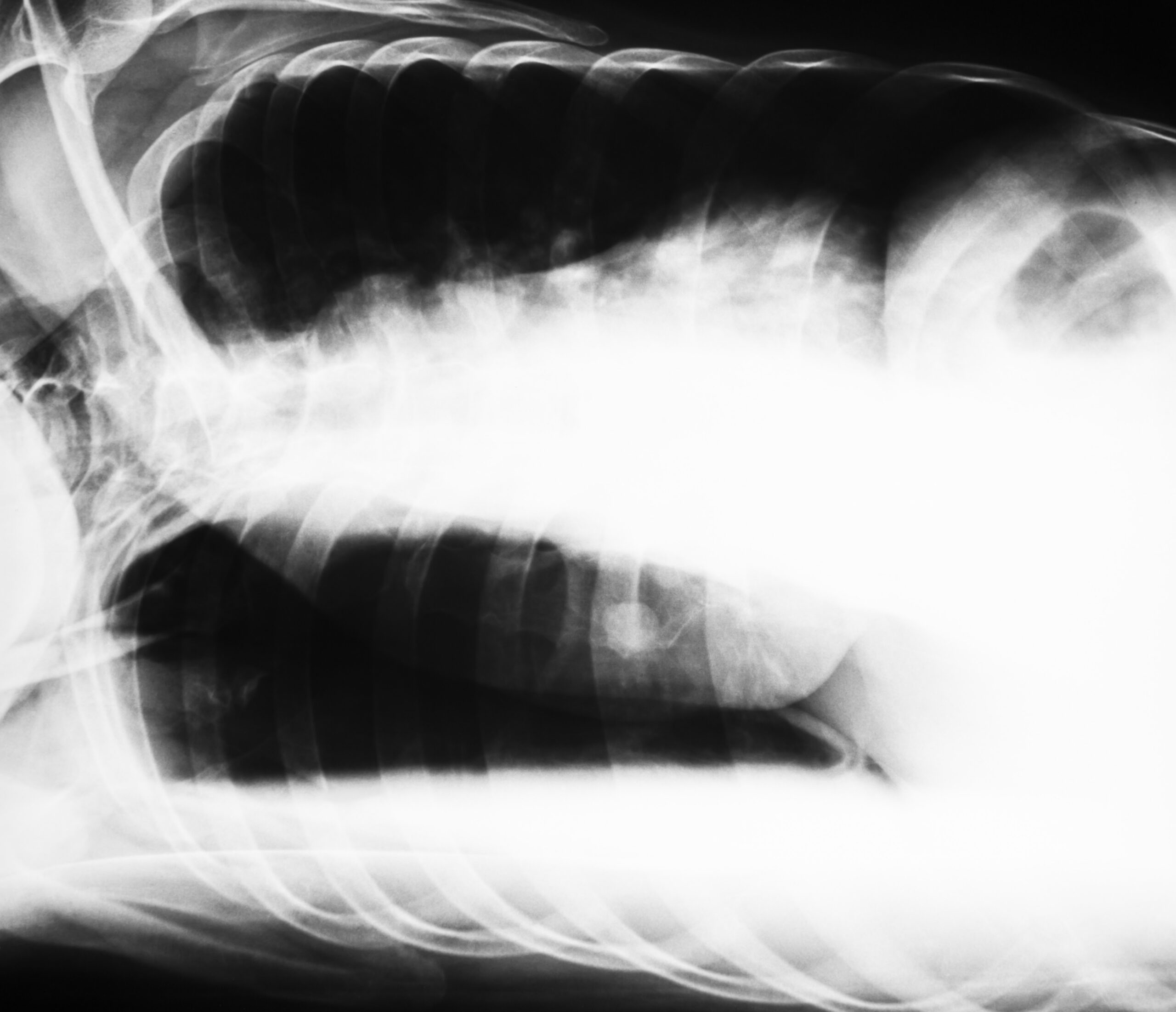 Chest, Chest Decubitus view, X-Ray
