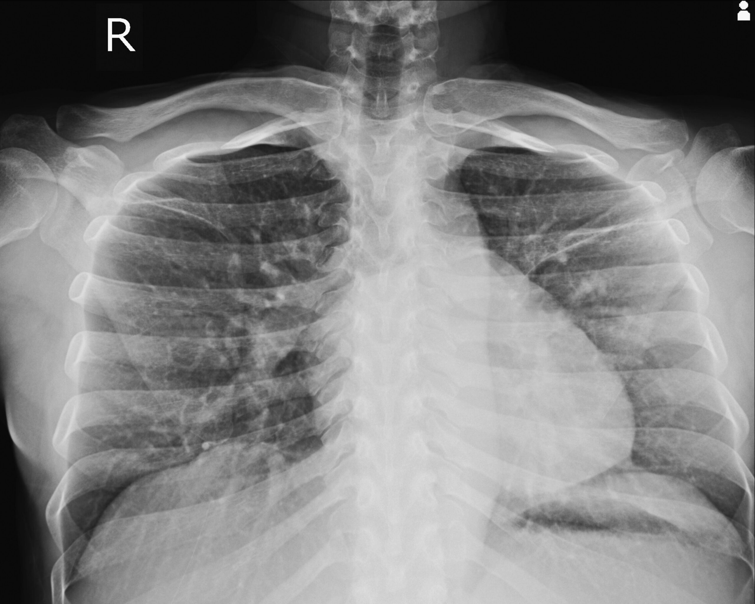 Chest, Chest Lordotic view, X-Ray