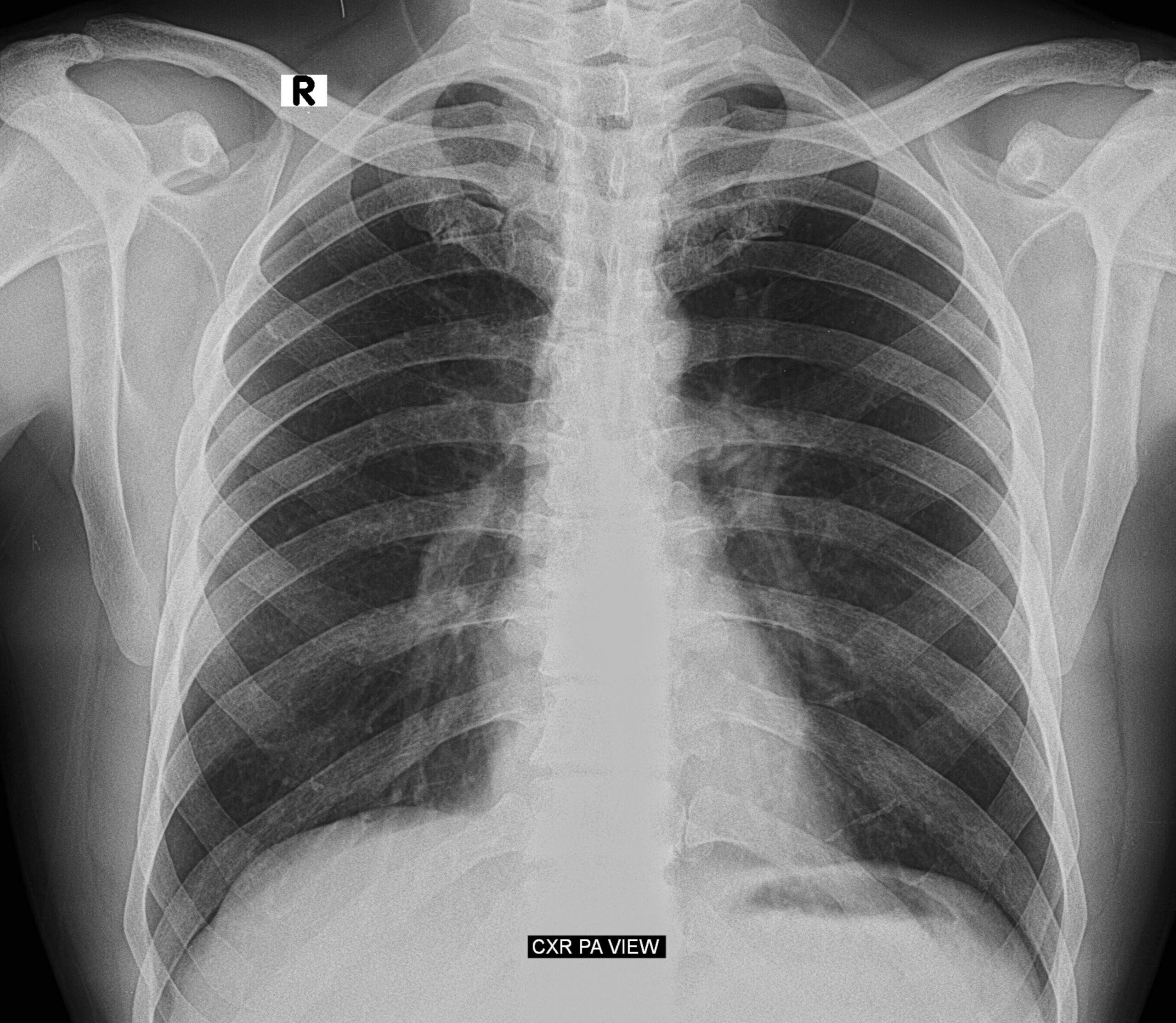 Chest, Chest PA view, X-Ray