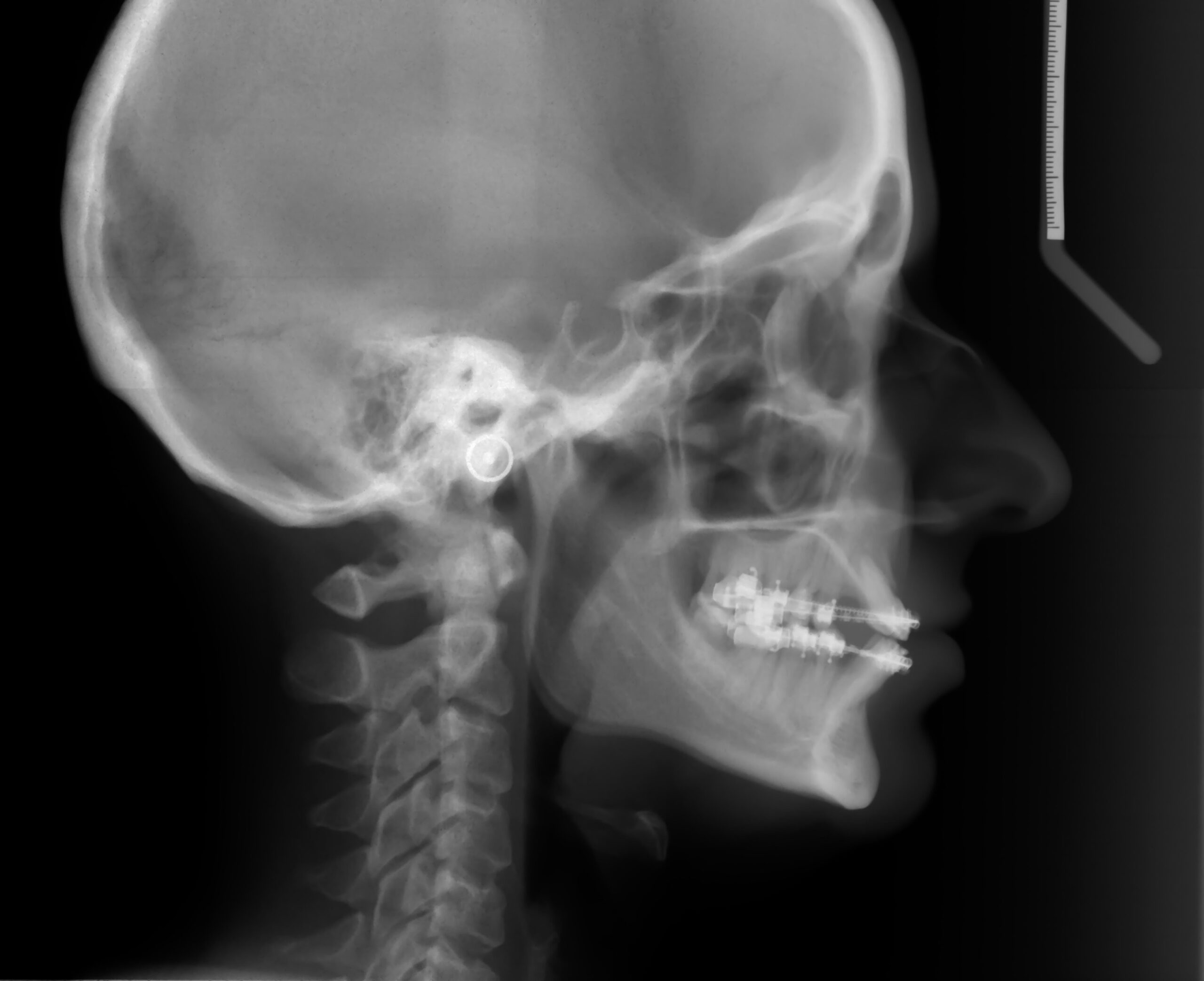 Face, Lateral View, X-Ray