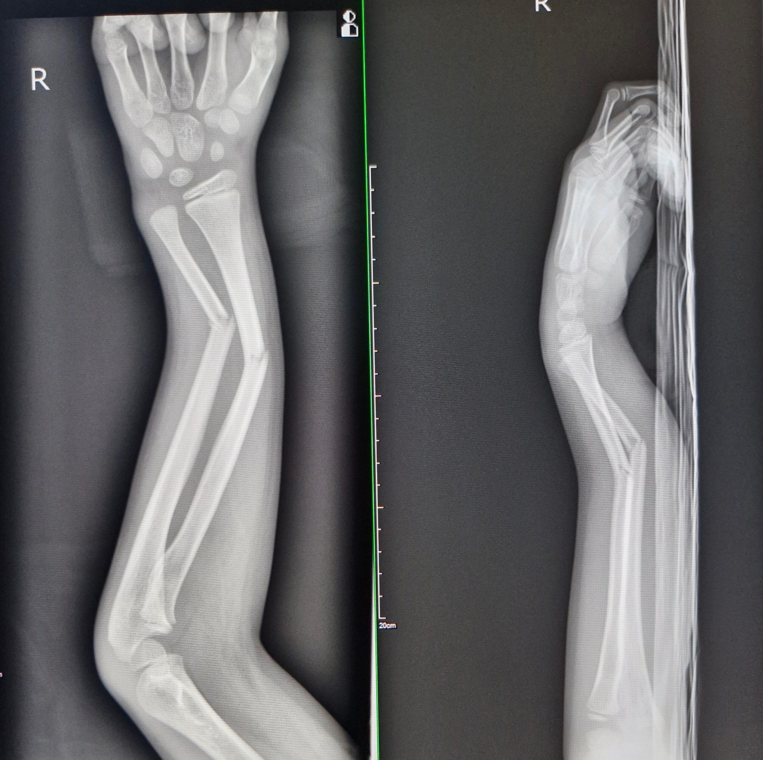 Forearm (Radius and Ulna), Lateral view, X-Ray