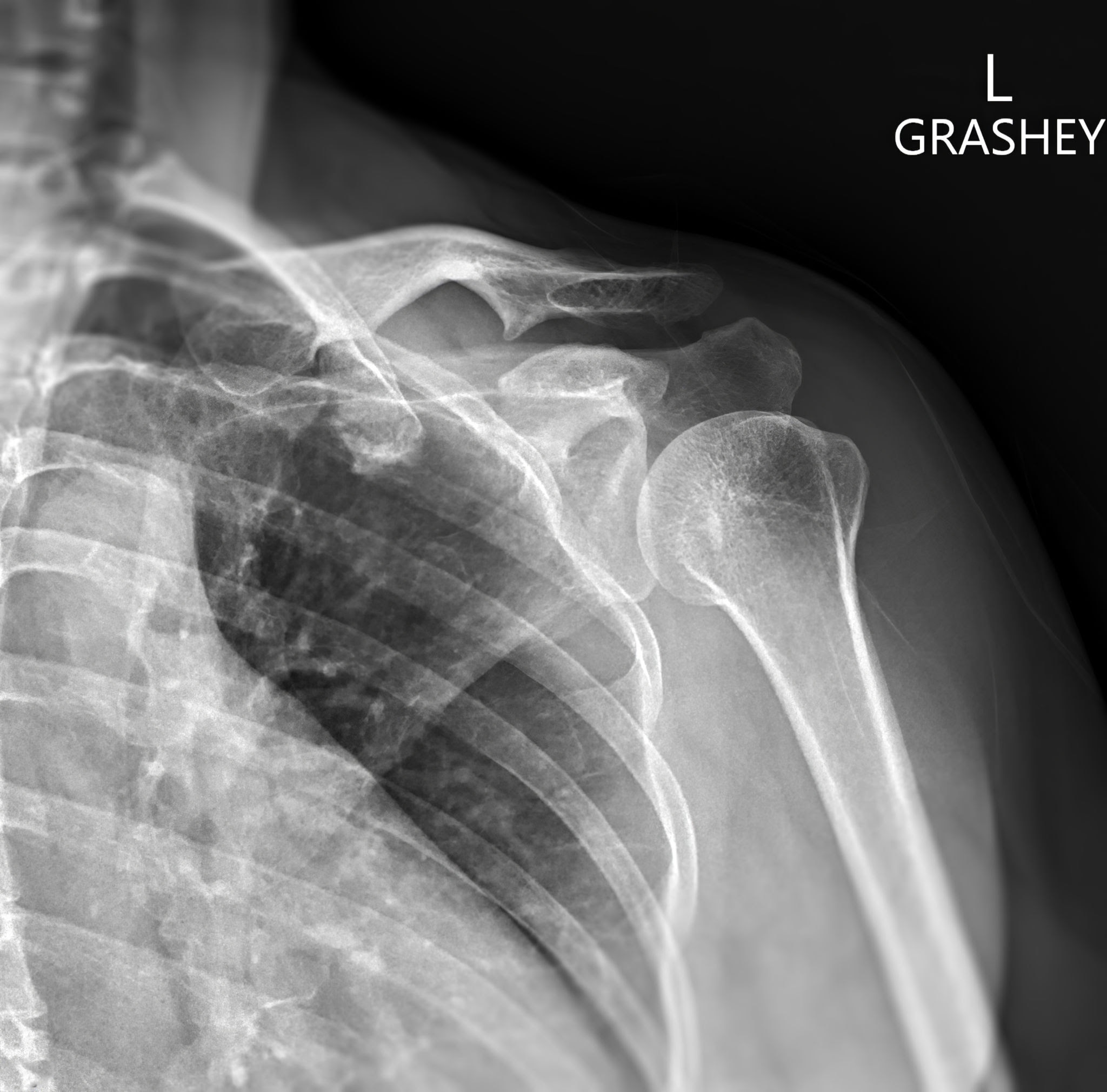 Grashey view, Shoulder, X-Ray