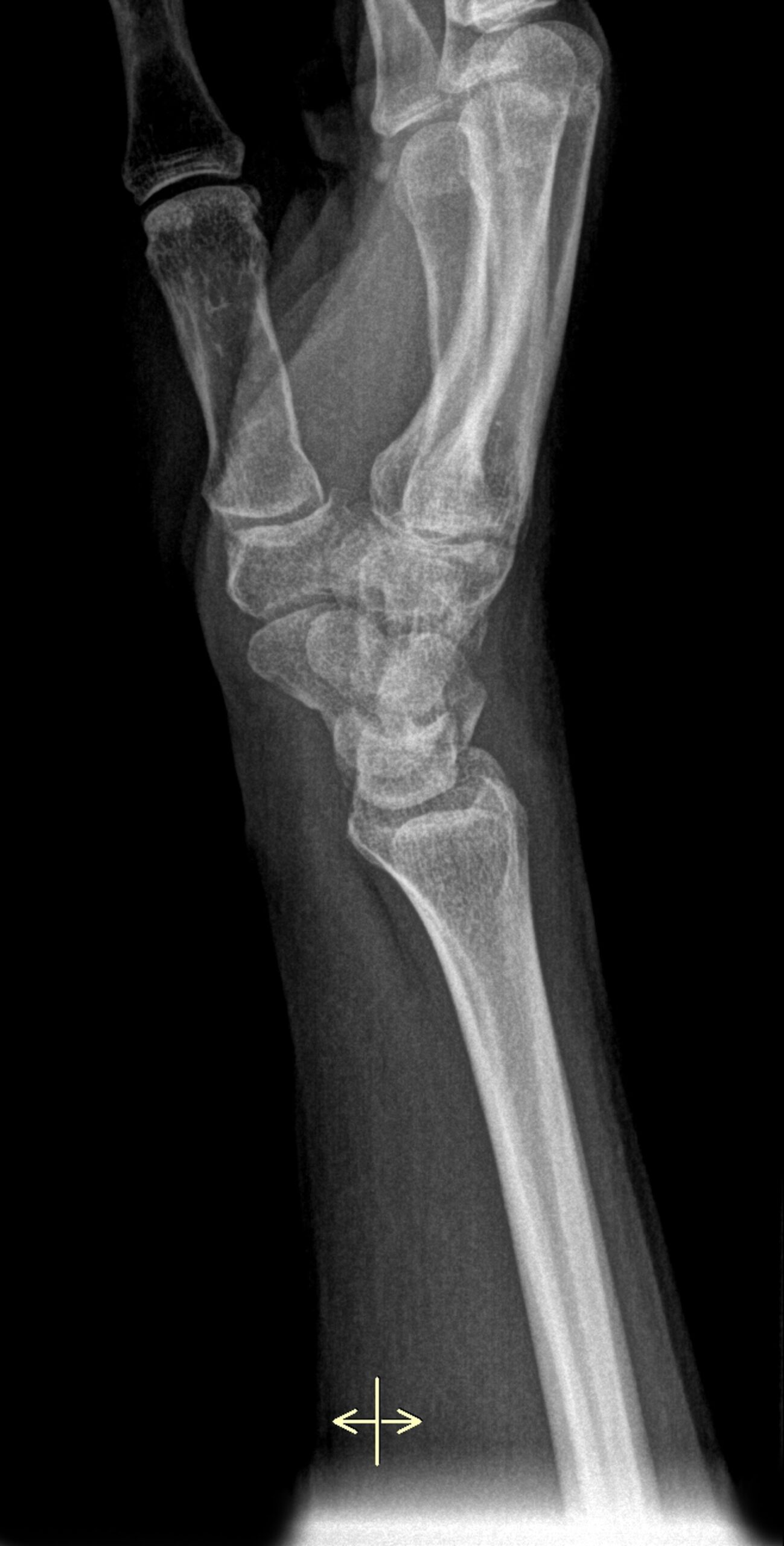 Lateral view, Wrist, X-Ray