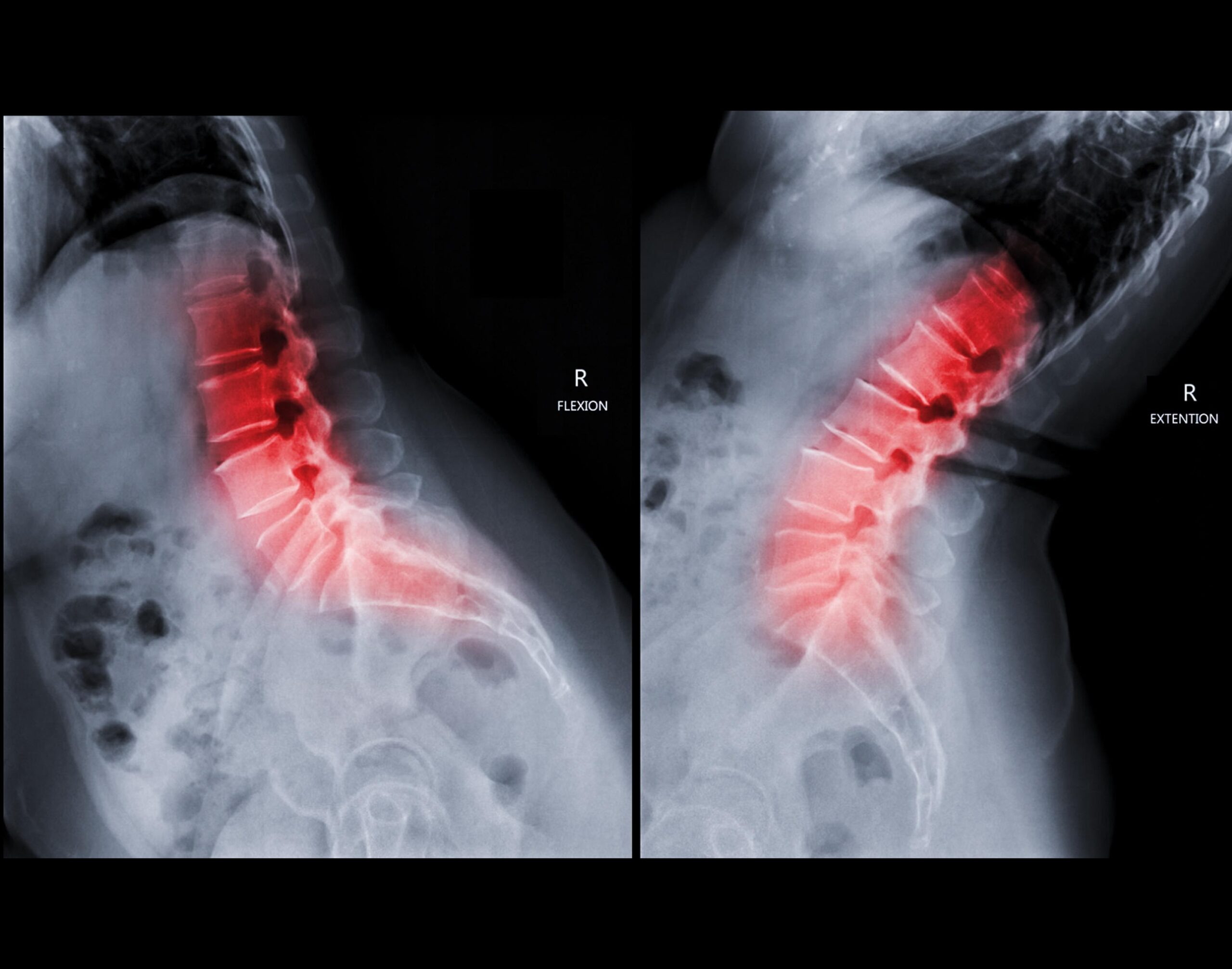 Lumbar spine Flexion,Extension, Spine, X-Ray