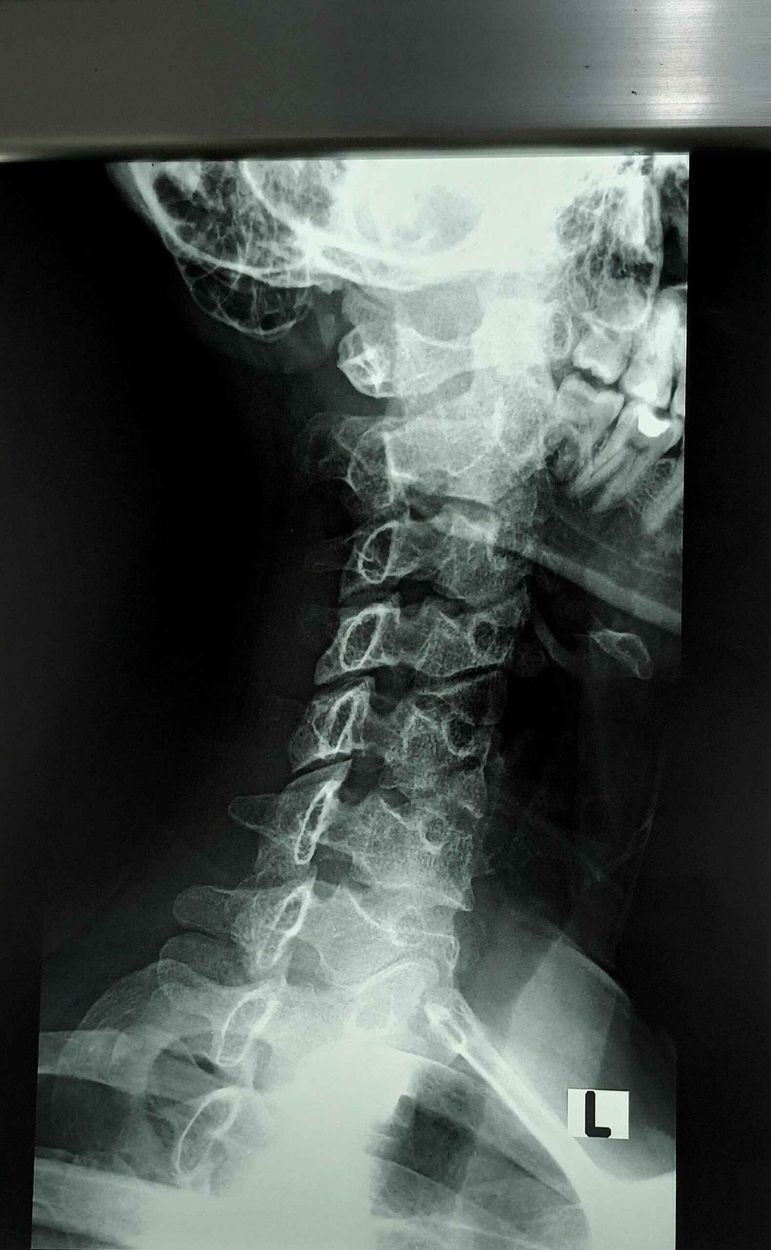 Lumbar spine oblique, Spine, X-Ray