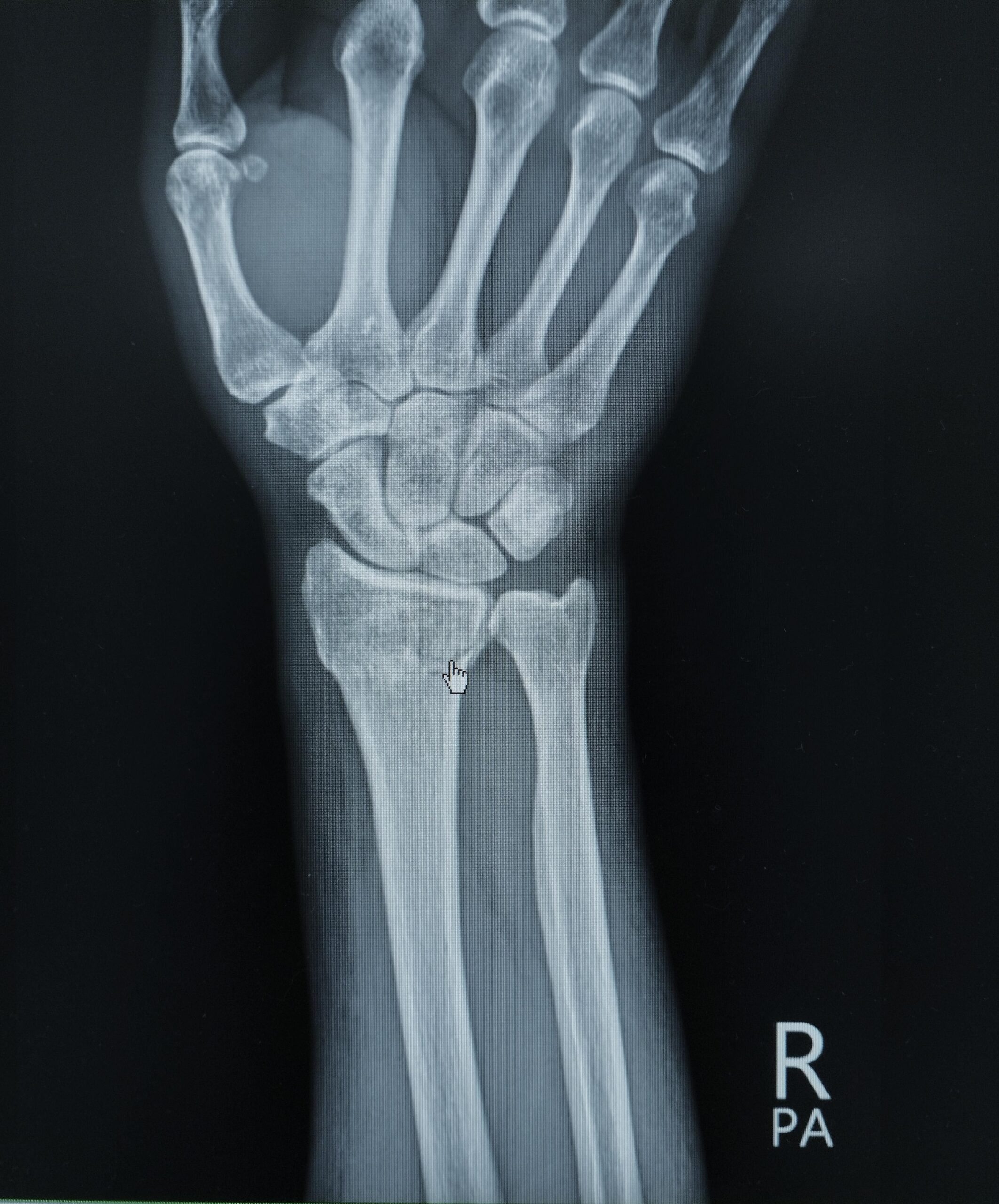 Oblique view, Wrist, X-Ray