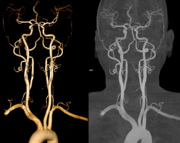 Brain & Neck Angiography