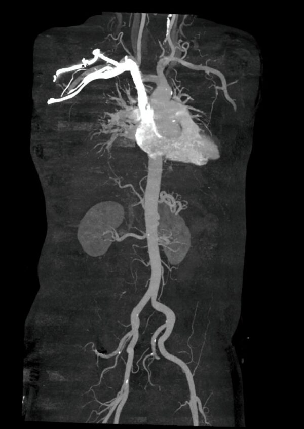 Renal Angiography