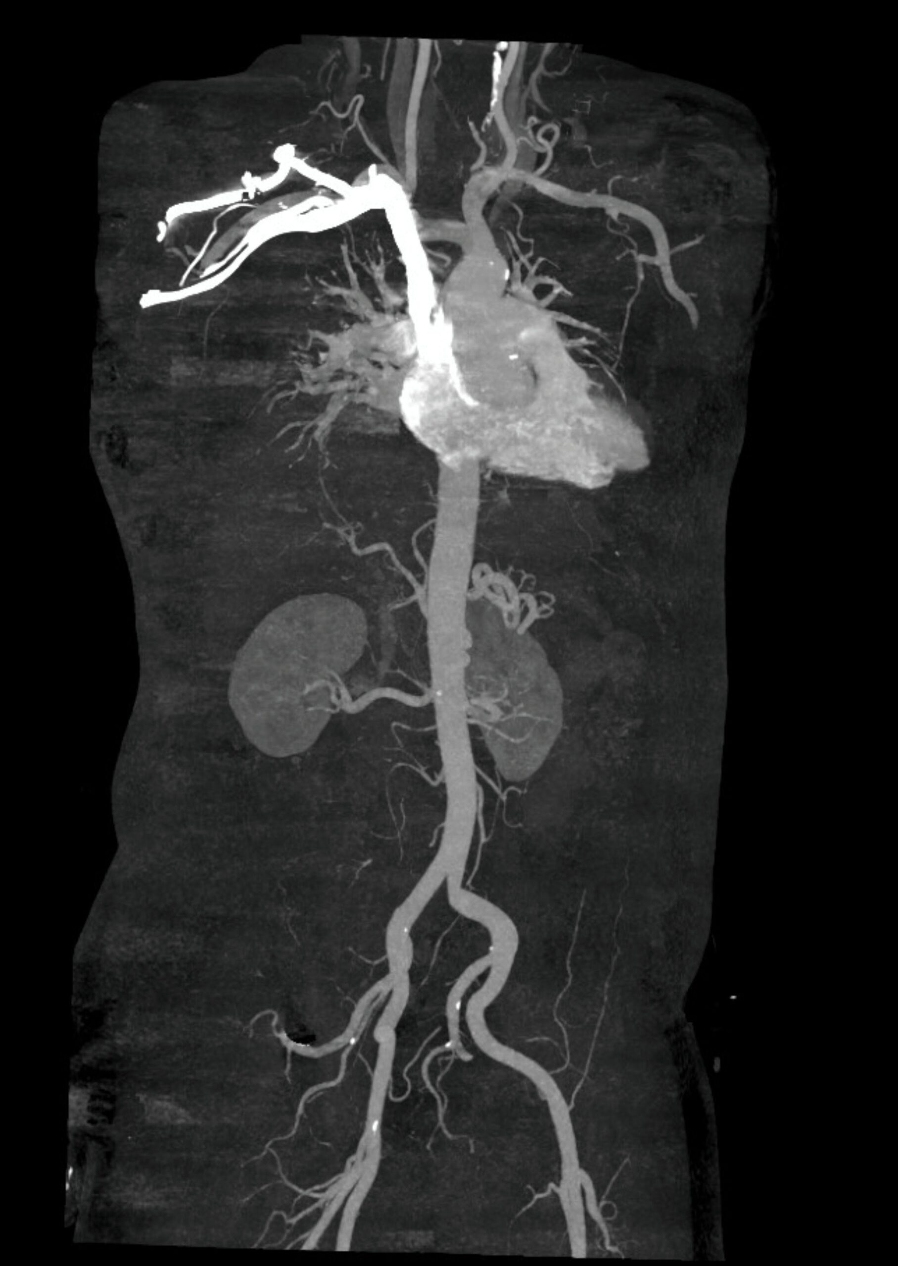 AngiographyVenogram, CT Scan, Renal Angiography