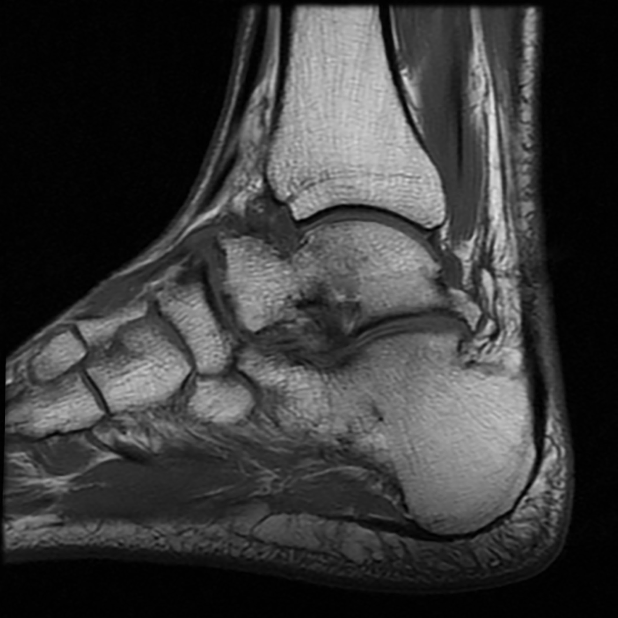Ankle Joint (Right-Left-Both), Lower Limbs, MRI