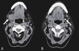 CT Scan, Face, Submandibular region with Contrast