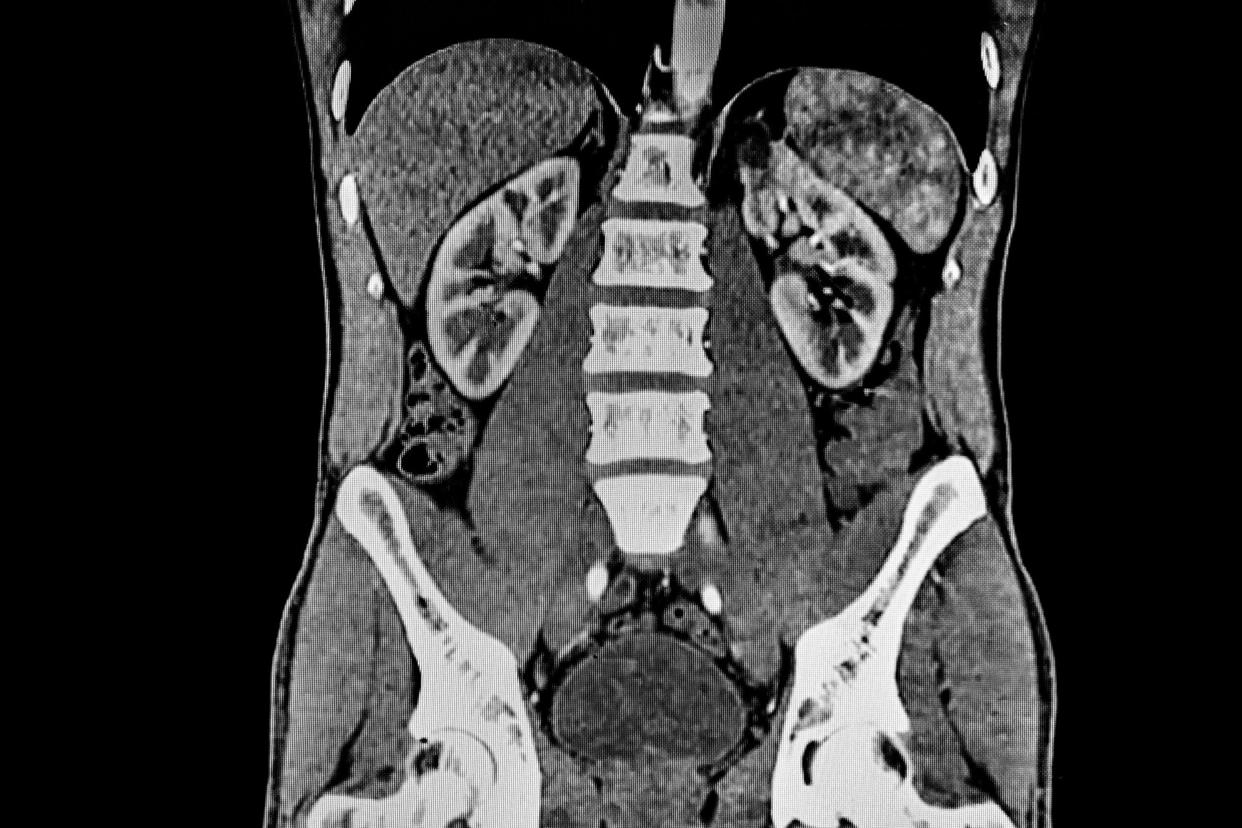 CT Scan, Pelvis, Pelvis with Contrast